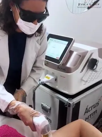 Depilação a laser na axila, com o aparelho ao lado da maca